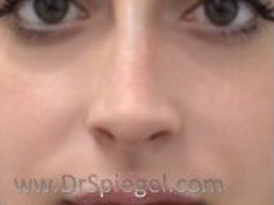 Non-Surgical Rhinoplasty / Nose Filler Before & After Gallery - Patient 104554 - Image 2