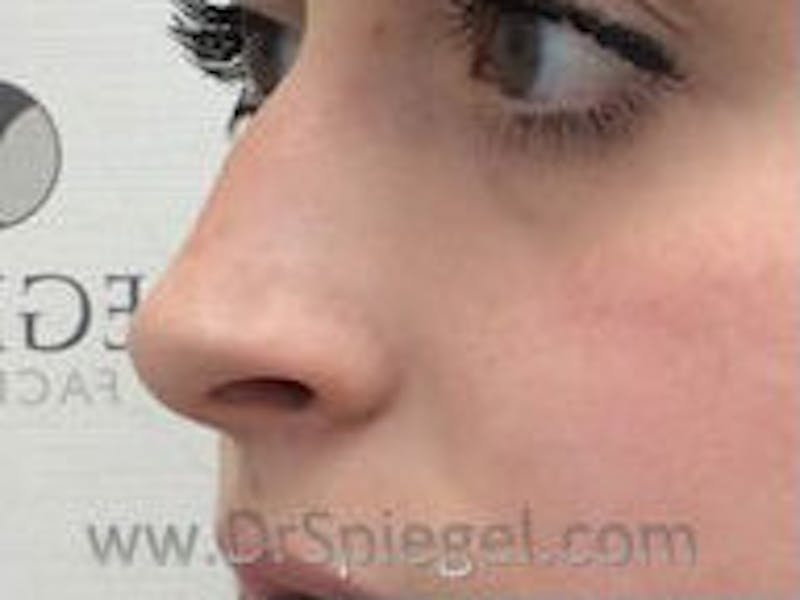 Non-Surgical Rhinoplasty / Nose Filler Before & After Gallery - Patient 104554 - Image 3