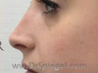 Non-Surgical Rhinoplasty / Nose Filler Before & After Gallery - Patient 104554 - Image 4