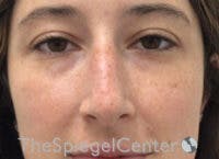 Non-Surgical Rhinoplasty / Nose Filler Before & After Gallery - Patient 596894 - Image 1