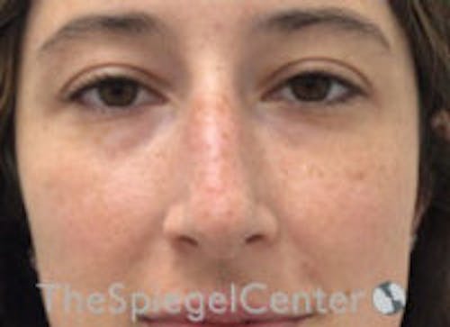 Non-Surgical Rhinoplasty / Nose Filler Before & After Gallery - Patient 596894 - Image 1