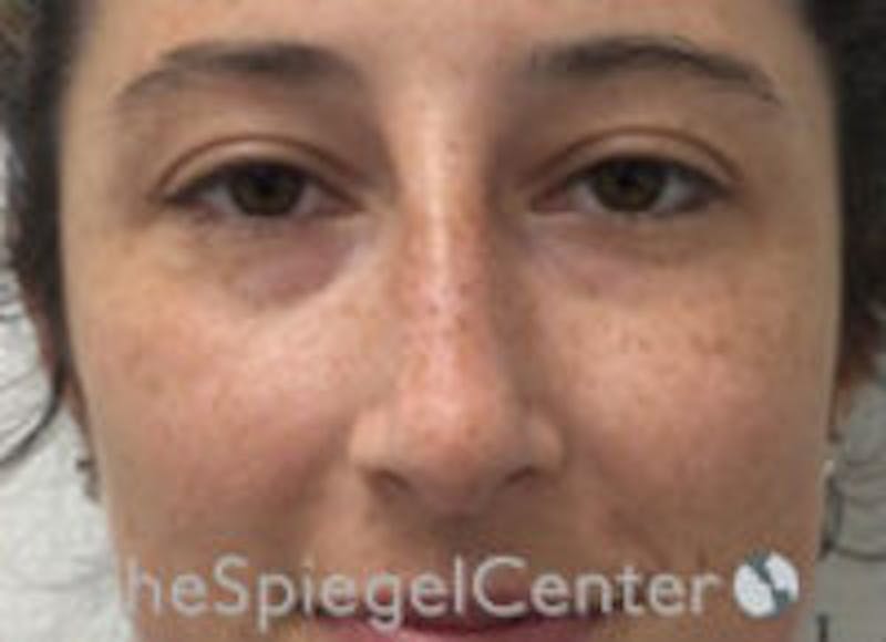 Non-Surgical Rhinoplasty / Nose Filler Before & After Gallery - Patient 596894 - Image 2