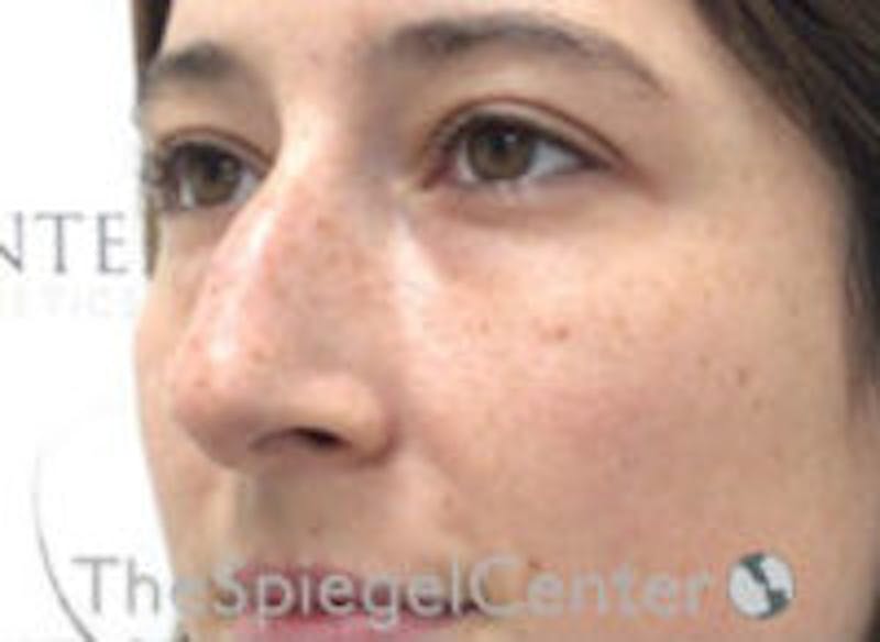 Non-Surgical Rhinoplasty / Nose Filler Before & After Gallery - Patient 596894 - Image 3