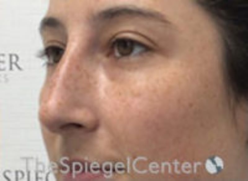 Non-Surgical Rhinoplasty / Nose Filler Before & After Gallery - Patient 596894 - Image 4