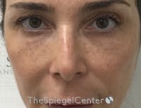 Non-Surgical Rhinoplasty / Nose Filler Before & After Gallery - Patient 103696 - Image 1