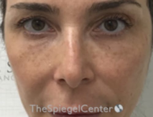 Non-Surgical Rhinoplasty / Nose Filler Before & After Gallery - Patient 103696 - Image 1