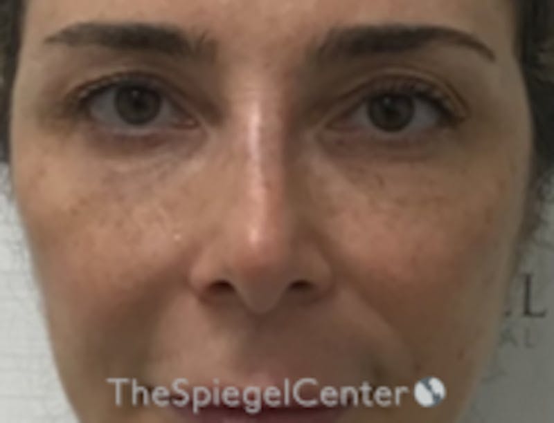 Non-Surgical Rhinoplasty / Nose Filler Before & After Gallery - Patient 103696 - Image 2