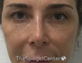 Non-Surgical Rhinoplasty / Nose Filler Before & After Gallery - Patient 103696 - Image 2