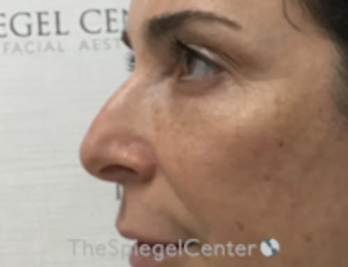 Non-Surgical Rhinoplasty / Nose Filler Before & After Gallery - Patient 103696 - Image 3