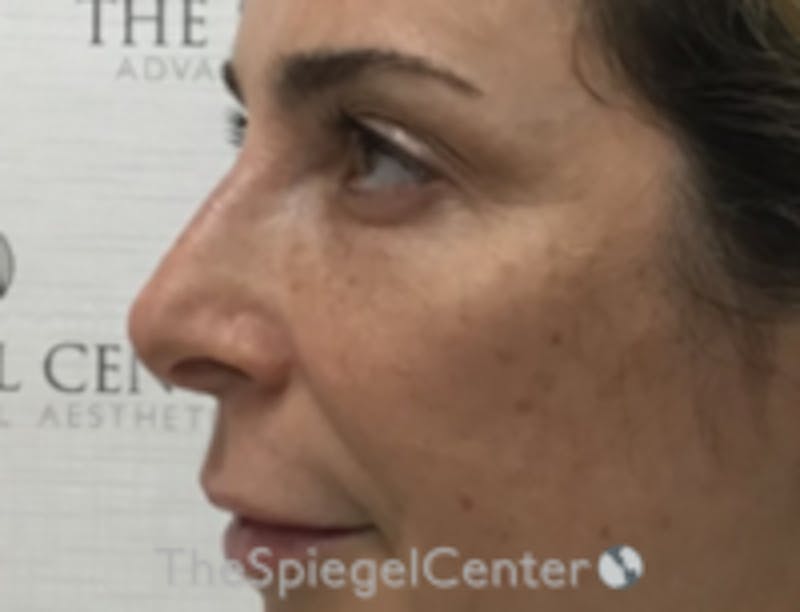 Non-Surgical Rhinoplasty / Nose Filler Before & After Gallery - Patient 103696 - Image 4