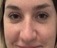Non-Surgical Rhinoplasty / Nose Filler Before & After Gallery - Patient 801612 - Image 1