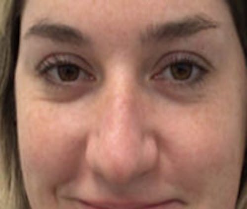 Non-Surgical Rhinoplasty / Nose Filler Before & After Gallery - Patient 801612 - Image 1