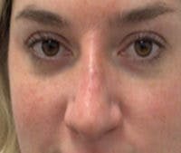 Non-Surgical Rhinoplasty / Nose Filler Before & After Gallery - Patient 801612 - Image 2