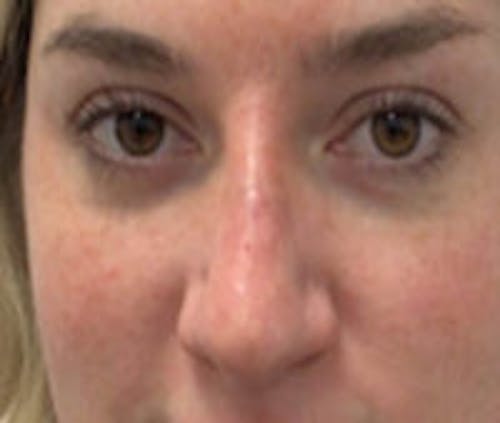 Non-Surgical Rhinoplasty / Nose Filler Before & After Gallery - Patient 801612 - Image 2