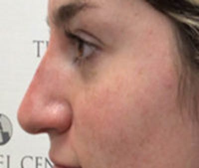 Non-Surgical Rhinoplasty / Nose Filler Before & After Gallery - Patient 801612 - Image 4