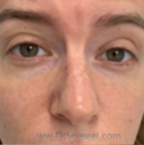 Non-Surgical Rhinoplasty / Nose Filler Before & After Gallery - Patient 811025 - Image 1