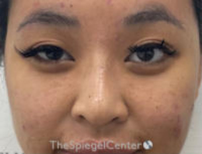 Non-Surgical Rhinoplasty / Nose Filler Before & After Gallery - Patient 345584 - Image 2