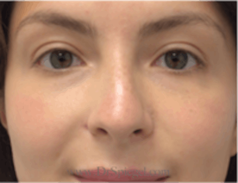 Non-Surgical Rhinoplasty / Nose Filler Before & After Gallery - Patient 301650 - Image 1