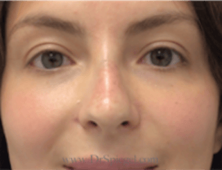Non-Surgical Rhinoplasty / Nose Filler Before & After Gallery - Patient 301650 - Image 2