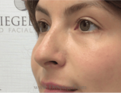 Non-Surgical Rhinoplasty / Nose Filler Before & After Gallery - Patient 301650 - Image 3