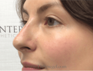 Non-Surgical Rhinoplasty / Nose Filler Before & After Gallery - Patient 301650 - Image 4
