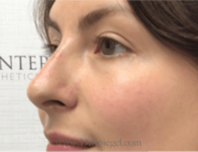 Non-Surgical Rhinoplasty / Nose Filler Before & After Gallery - Patient 301650 - Image 4