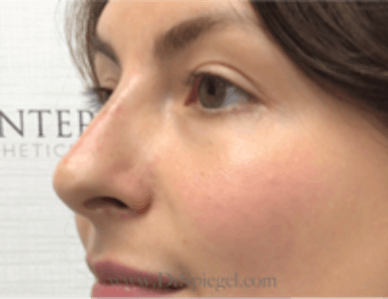 Non-Surgical Rhinoplasty / Nose Filler Before & After Gallery - Patient 301650 - Image 4