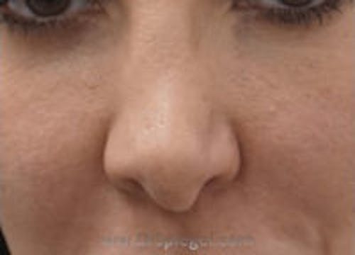 Non-Surgical Rhinoplasty / Nose Filler Before & After Gallery - Patient 291089 - Image 1