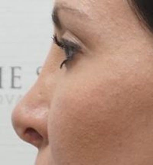 Non-Surgical Rhinoplasty / Nose Filler Before & After Gallery - Patient 291089 - Image 3
