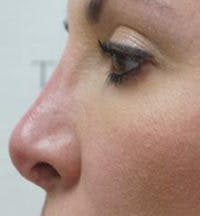 Non-Surgical Rhinoplasty / Nose Filler Before & After Gallery - Patient 291089 - Image 4