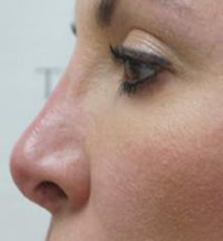Non-Surgical Rhinoplasty / Nose Filler Before & After Gallery - Patient 291089 - Image 4