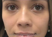 Non-Surgical Rhinoplasty / Nose Filler Before & After Gallery - Patient 622392 - Image 1