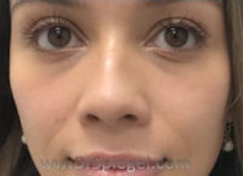 Non-Surgical Rhinoplasty / Nose Filler Before & After Gallery - Patient 622392 - Image 1