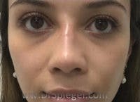 Non-Surgical Rhinoplasty / Nose Filler Before & After Gallery - Patient 622392 - Image 2