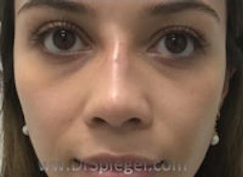 Non-Surgical Rhinoplasty / Nose Filler Before & After Gallery - Patient 622392 - Image 2