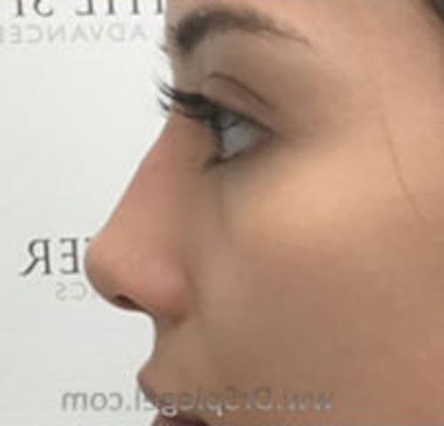 Non-Surgical Rhinoplasty / Nose Filler Before & After Gallery - Patient 622392 - Image 4