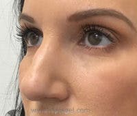 Non-Surgical Rhinoplasty / Nose Filler Before & After Gallery - Patient 226082 - Image 1