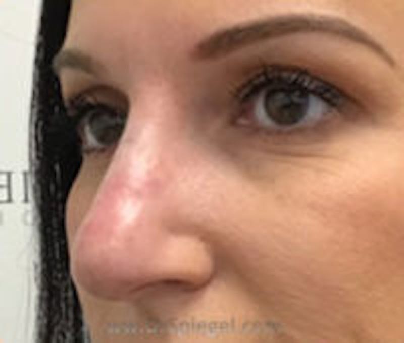 Non-Surgical Rhinoplasty / Nose Filler Before & After Gallery - Patient 226082 - Image 2