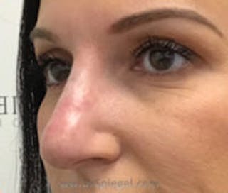 Non-Surgical Rhinoplasty / Nose Filler Before & After Gallery - Patient 226082 - Image 2