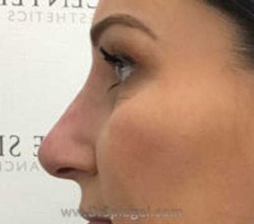 Non-Surgical Rhinoplasty / Nose Filler Before & After Gallery - Patient 226082 - Image 4