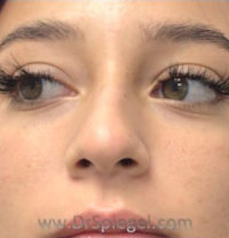 Non-Surgical Rhinoplasty / Nose Filler Before & After Gallery - Patient 124430 - Image 1