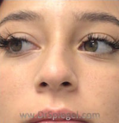 Non-Surgical Rhinoplasty / Nose Filler Before & After Gallery - Patient 124430 - Image 1