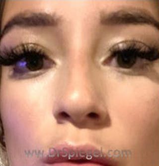 Non-Surgical Rhinoplasty / Nose Filler Before & After Gallery - Patient 124430 - Image 2