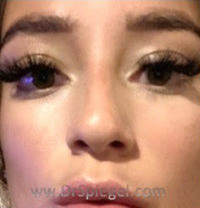Non-Surgical Rhinoplasty / Nose Filler Before & After Gallery - Patient 124430 - Image 2