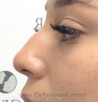 Non-Surgical Rhinoplasty / Nose Filler Before & After Gallery - Patient 124430 - Image 3