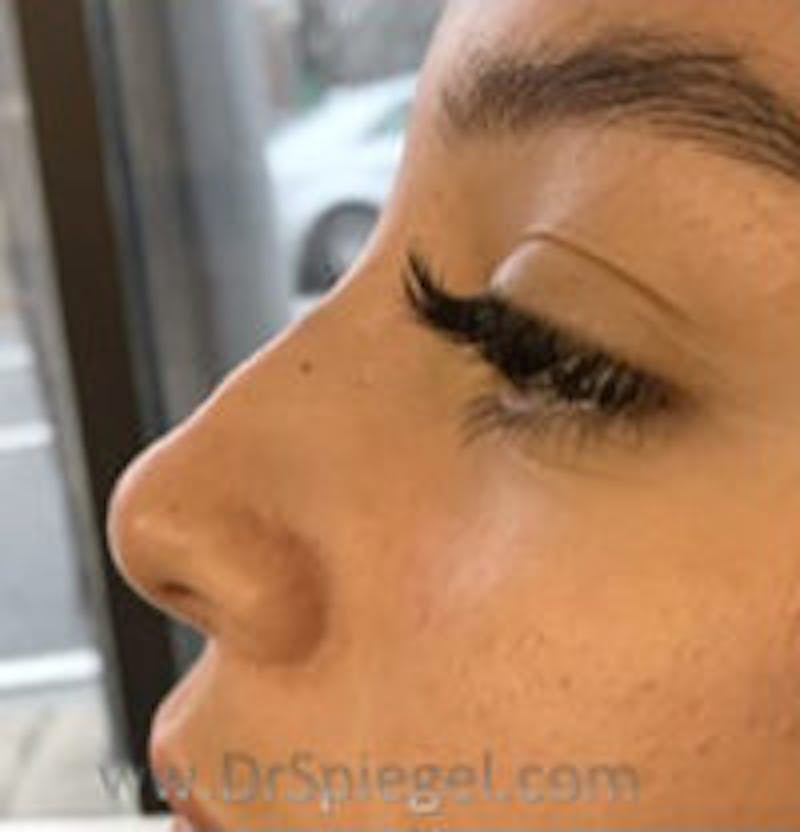 Non-Surgical Rhinoplasty / Nose Filler Before & After Gallery - Patient 124430 - Image 4
