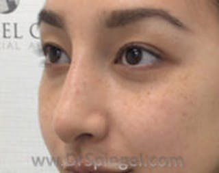 Non-Surgical Rhinoplasty / Nose Filler Before & After Gallery - Patient 429301 - Image 4