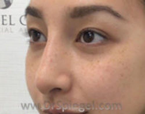 Non-Surgical Rhinoplasty Before & After Gallery - Patient 172442 - Image 4