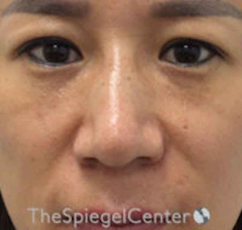 Non-Surgical Rhinoplasty / Nose Filler Before & After Gallery - Patient 223170 - Image 2