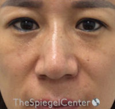 Non-Surgical Rhinoplasty Before & After Gallery - Patient 103979 - Image 2